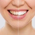 LÁPIZ BLANQUEADOR DE DIENTES – Elimina Manchas y Blanquea tu Sonrisa en Días | SMILE WHITE™